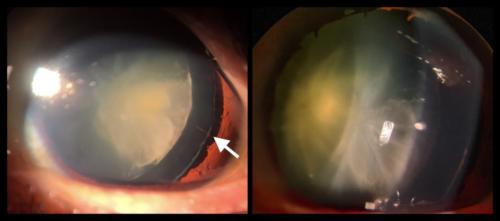 Cataract - traumatic - with lens dislocation